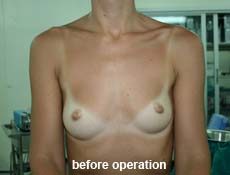 plastic-surgery-breast-augmentation 